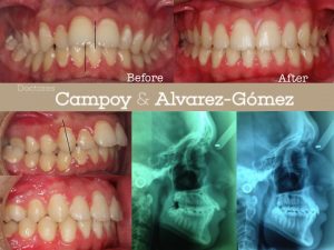 Ortodoncia: centrado línea media / Clínica dental Campoy & Álavarez-Gómez