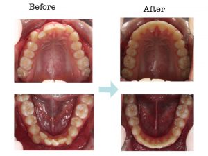 apiñamiento dentario, ortodoncia