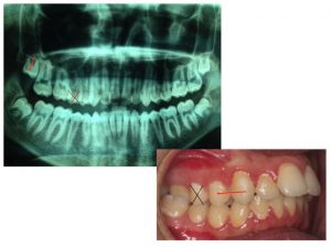 Ortodoncia: Extracción unilateral de premolar | Clínica Dental Campoy & Álvarez-Gómez