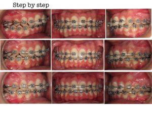 Ortodoncia: Dientes centrados con la cara | Clínica Dental Campoy & Álvarez-Gómez