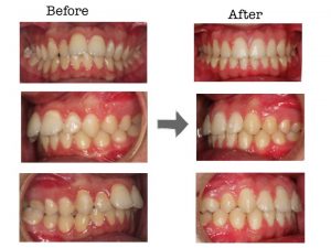 Ortodoncia: Extracción de segundo premolar | Clínica Dental Campoy & Álvarez-Gómez
