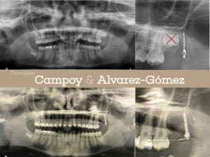 Clínica Dental Campoy & Álvarez-Gómez. Microtornillo retromolar, extraccion de cordal