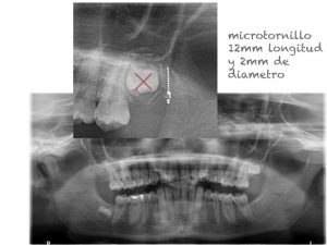 Clínica Dental Campoy & Álvarez-Gómez. Exodoncia cordal y colocación de microtornillo