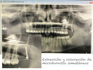 Clínica Dental Campoy & Álvarez-Gómez. Microtornillo retromolar