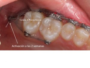 Clínica Dental Campoy & Álvarez-Gómez. Activación microtornillo retromolar