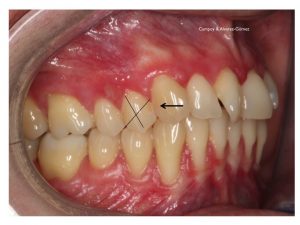 Ortodoncia, paciente periodontal