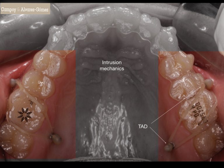 Control de mordida abierta con alineadores + TADS Clínica Dental