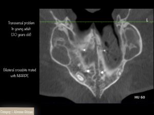 disyunción esquelética, ortodoncia murcia, campoy & Alvarez-gómez