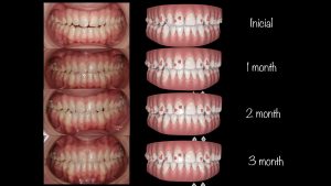 invisalign, ortodoncia Murcia, Campoy & Alvarez-Gomez, tad, ortodoncia invisible murcia