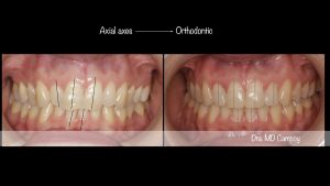 Axial exes, md.campoy.orthodontics, dental aesthetics