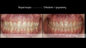 gingivla margins, md.campoy.orhodontics, dental aesthetics