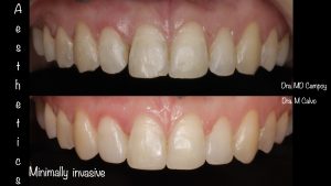 dental aesthetics, ortodoncia murcia, md.campoy.orthodontics