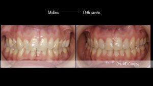 md.campoy.orthodontics, tad, miniscrew, midline