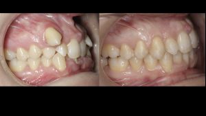 mdcampoyorthodontics, tratamiento ortodoncia murcia, canino incluido