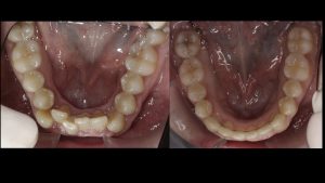 Apiñamiento inferior, ortodoncia invisalign murcia, estetica dental murcia