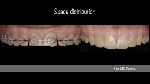 Desgastes dentarios, Clinica ortodoncia Murcia, ortodoncia murcia, Dra Campoy, Descastes dentarios, reconstrucciones minimamente invasivas, Campoy&Alvarez-Gómez