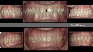 Desgastes dentarior, Clinica ortodoncia Murcia, ortodoncia murcia, Dra Campoy, Descastes dentarios, reconstrucciones minimamente invasivas, Campoy&Alvarez-Gómez