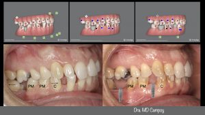 ortodoncia invisible murcia, Invisalign murcia, diastemas con Invisalign