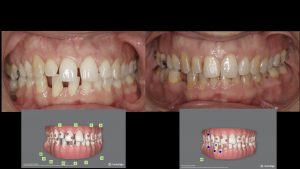 Invisalign Murcia, ortodoncia invisible Murcia, Campoy&amp;Alvarez-Gómez, md.campoy.orthodontics, diademas Invisalign, implantes